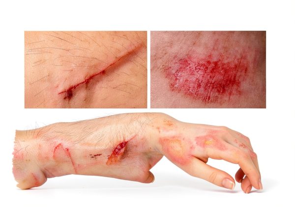 SilverSeal Hydrogel Wound Care Kit with Antimicrobial Silver Pads-4